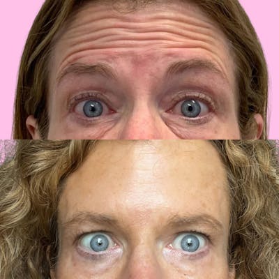 Jeuveau Before & After Gallery - Patient 133227239 - Image 1