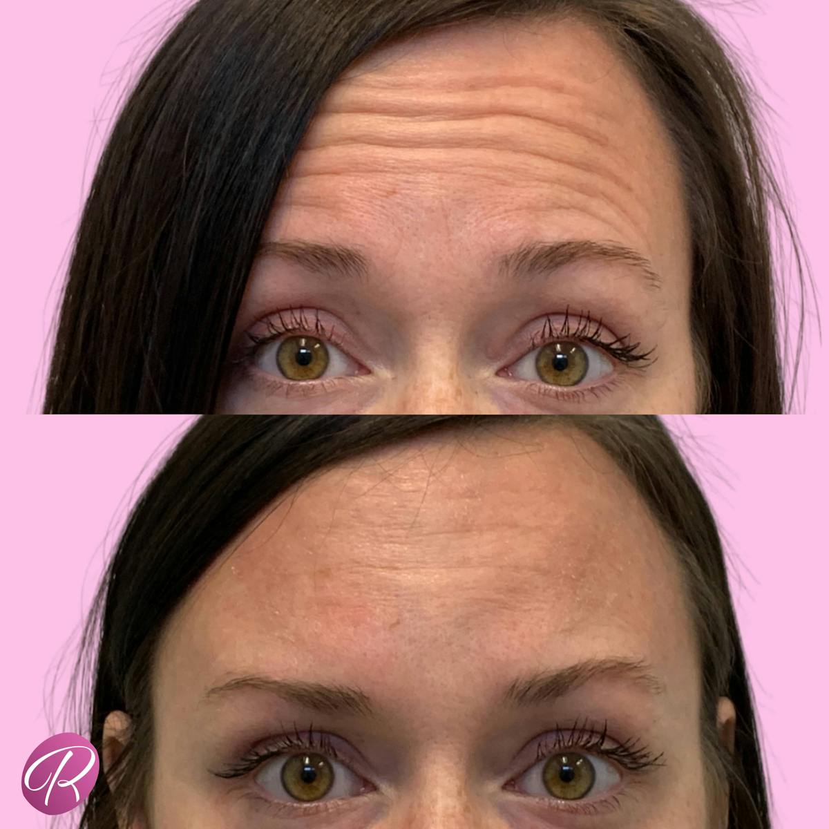 Jeuveau Before & After Gallery - Patient 133227361 - Image 2