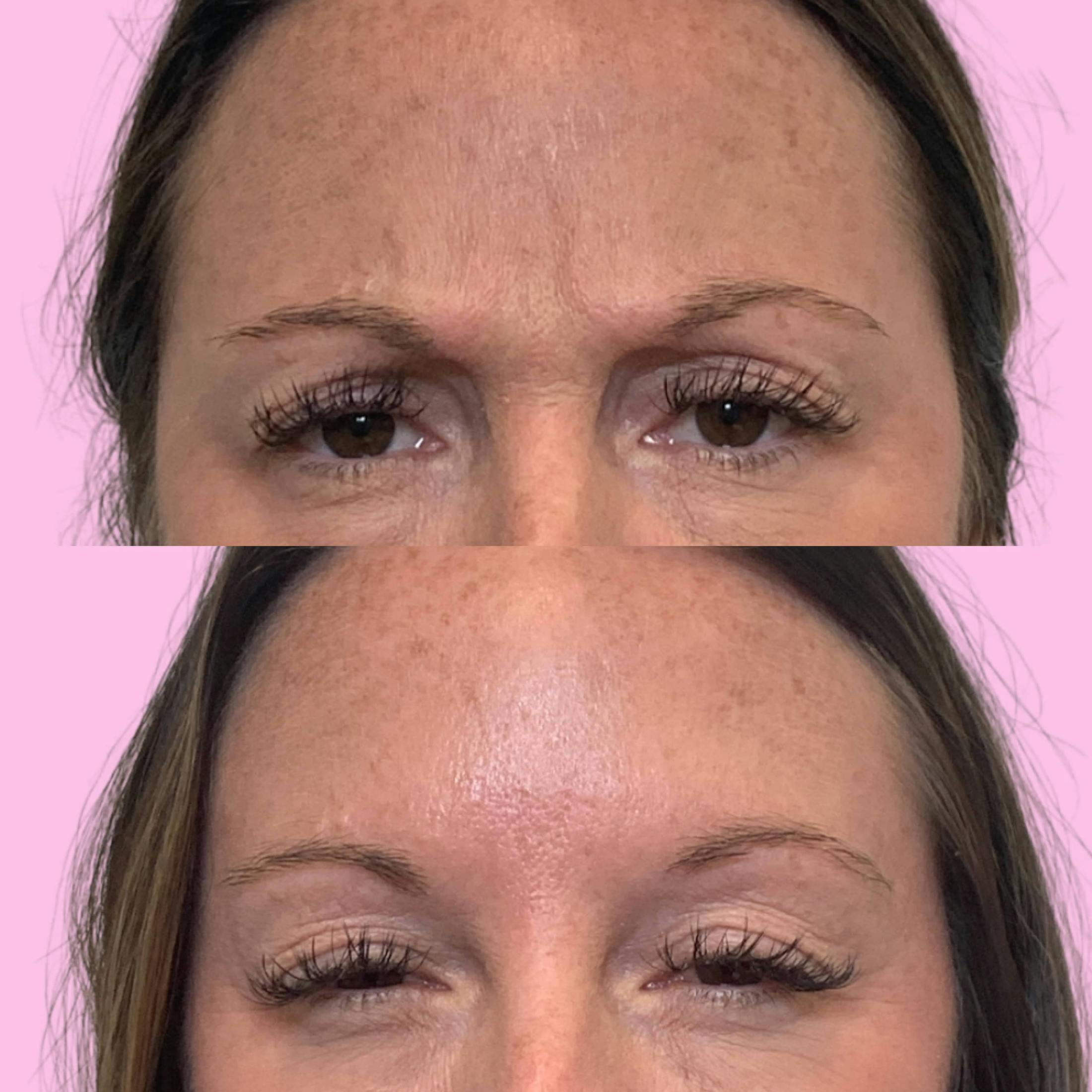 Jeuveau Before & After Gallery - Patient 133227362 - Image 2