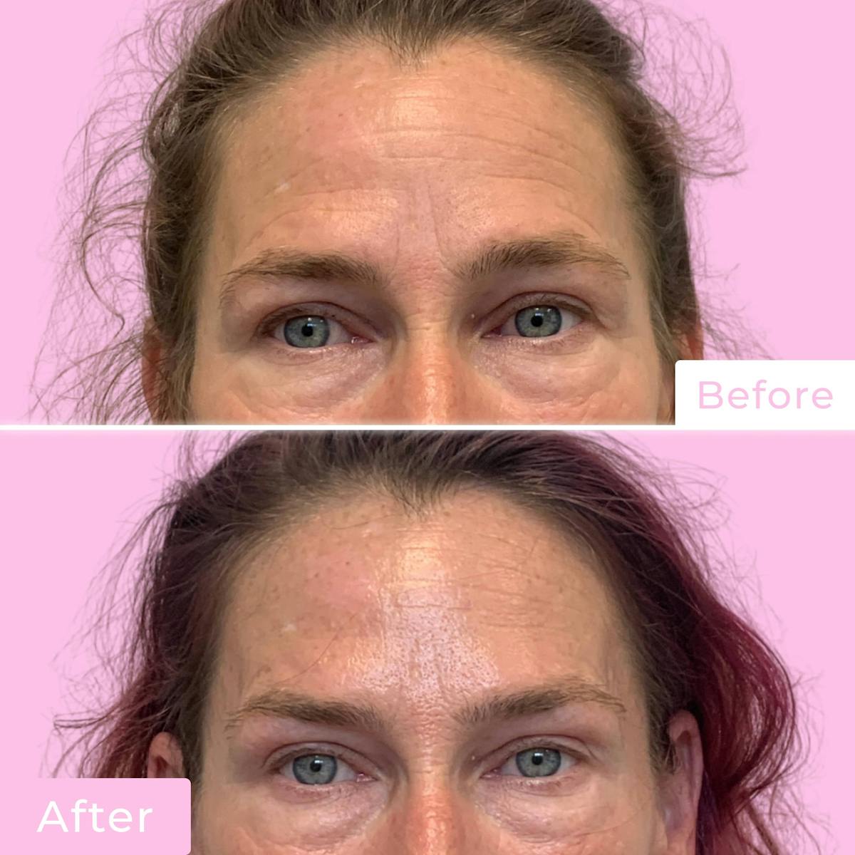 Jeuveau Before & After Gallery - Patient 133227365 - Image 3