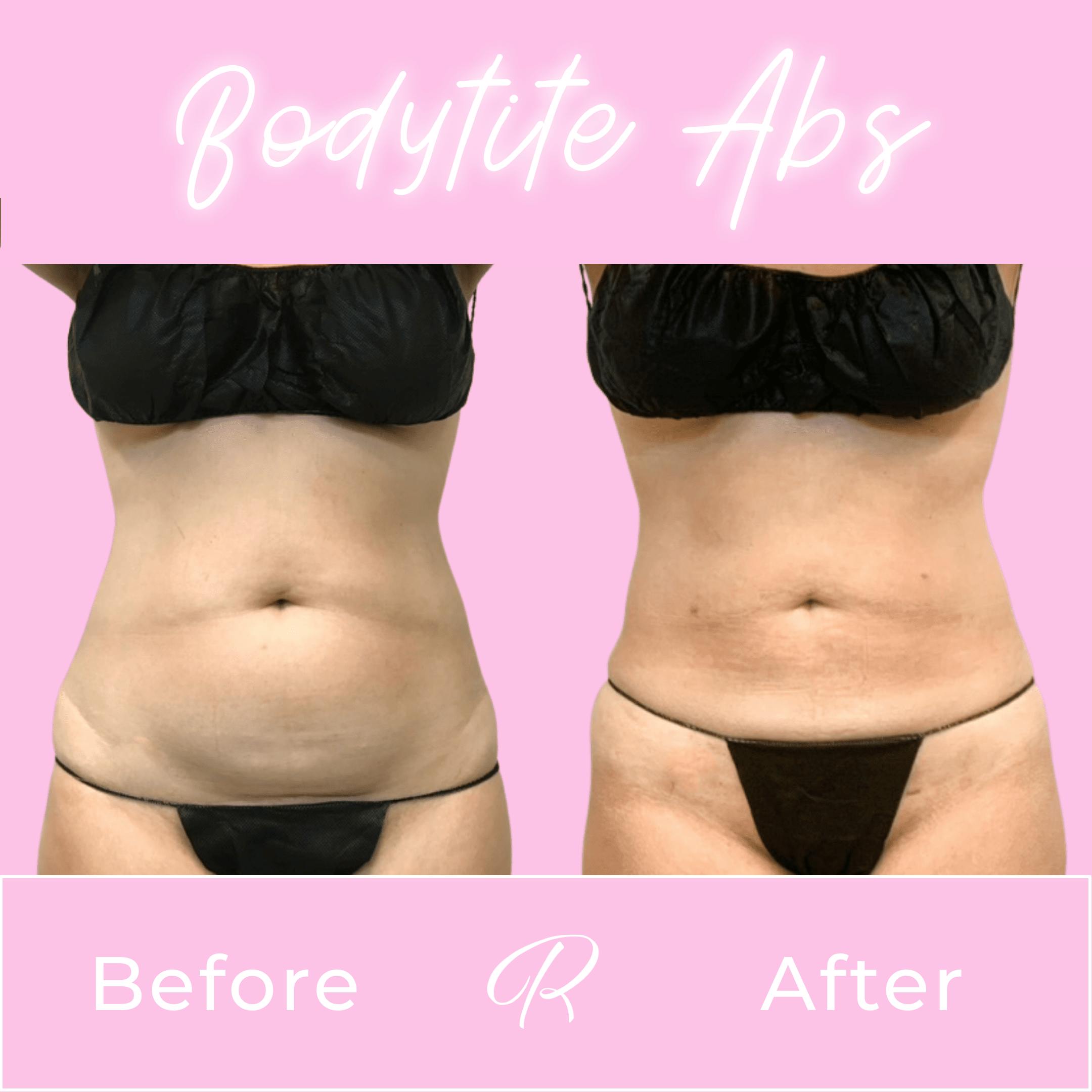 Bodytite