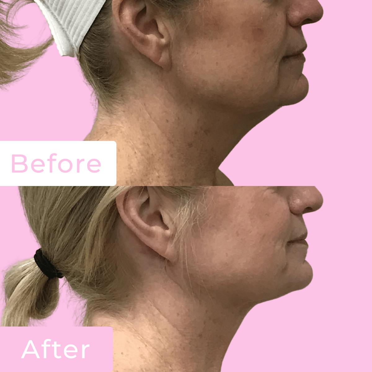 FaceTite Before & After Gallery - Patient 133227654 - Image 1