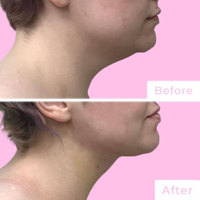 FaceTite Before & After Gallery - Patient 133227655 - Image 1
