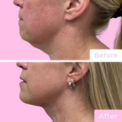 FaceTite Before & After Gallery - Patient 133227656 - Image 1
