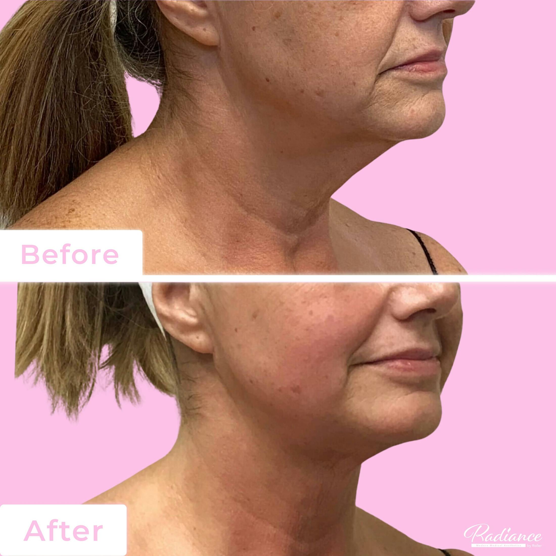FaceTite Before & After Gallery - Patient 133227657 - Image 1