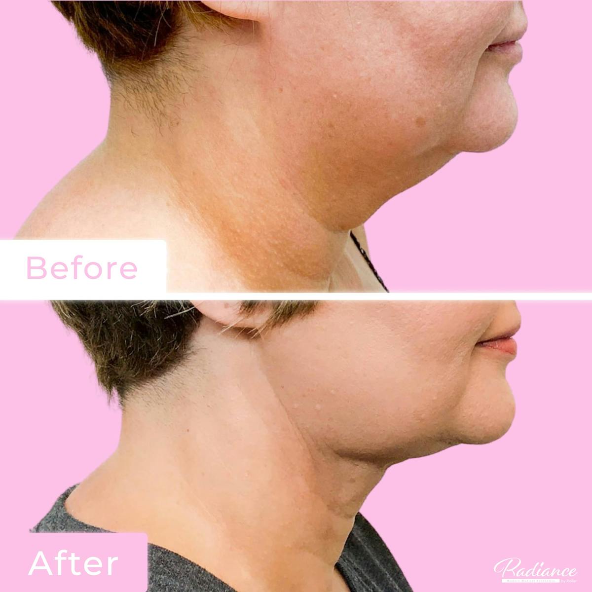 FaceTite Before & After Gallery - Patient 133227658 - Image 1