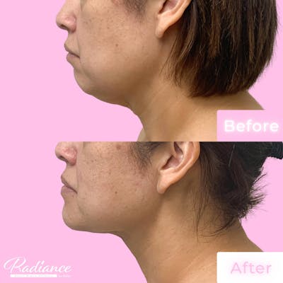 Neck Lift Before & After Gallery - Patient 133227661 - Image 1