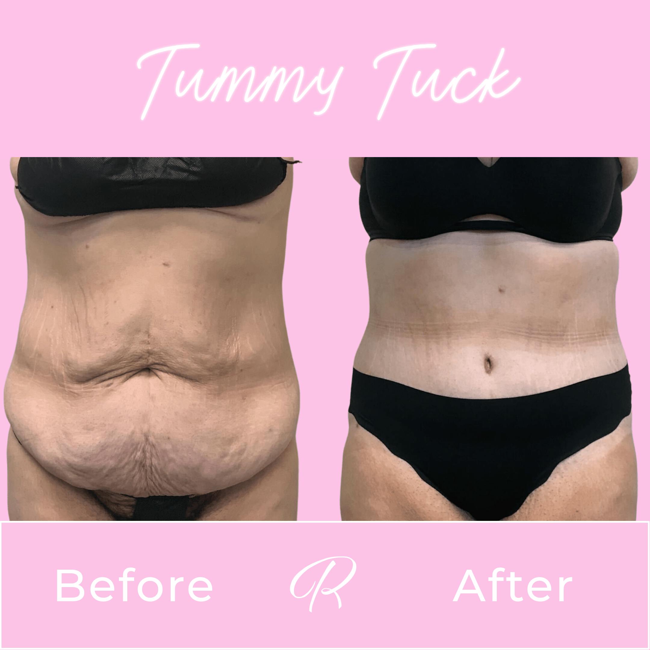 Tummy Tuck Before & After Gallery - Patient 133227667 - Image 1