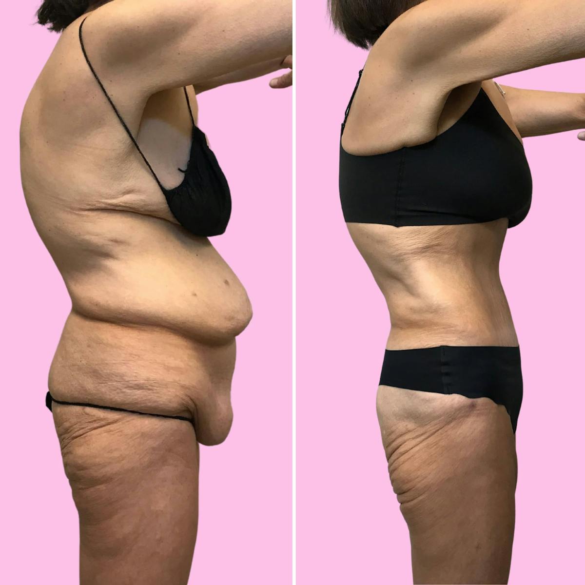 Tummy Tuck Before & After Gallery - Patient 133227668 - Image 2