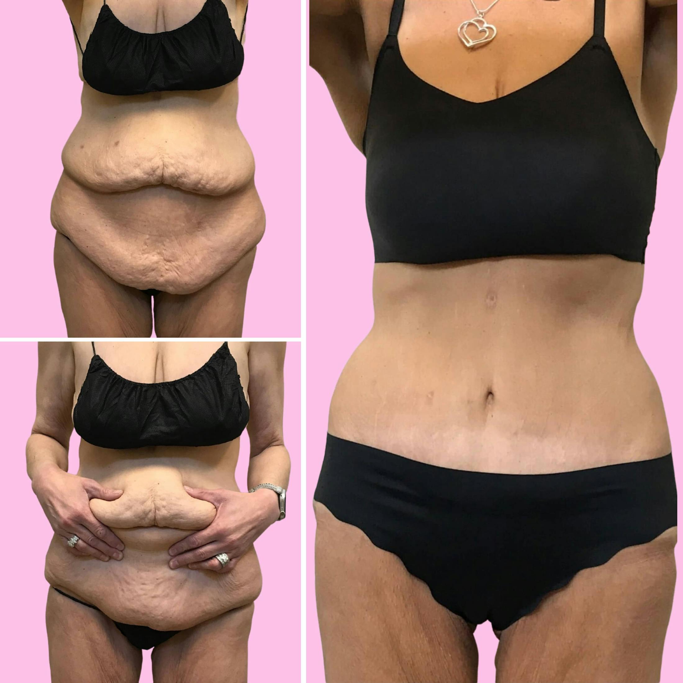 Tummy Tuck Before & After Gallery - Patient 133227668 - Image 1