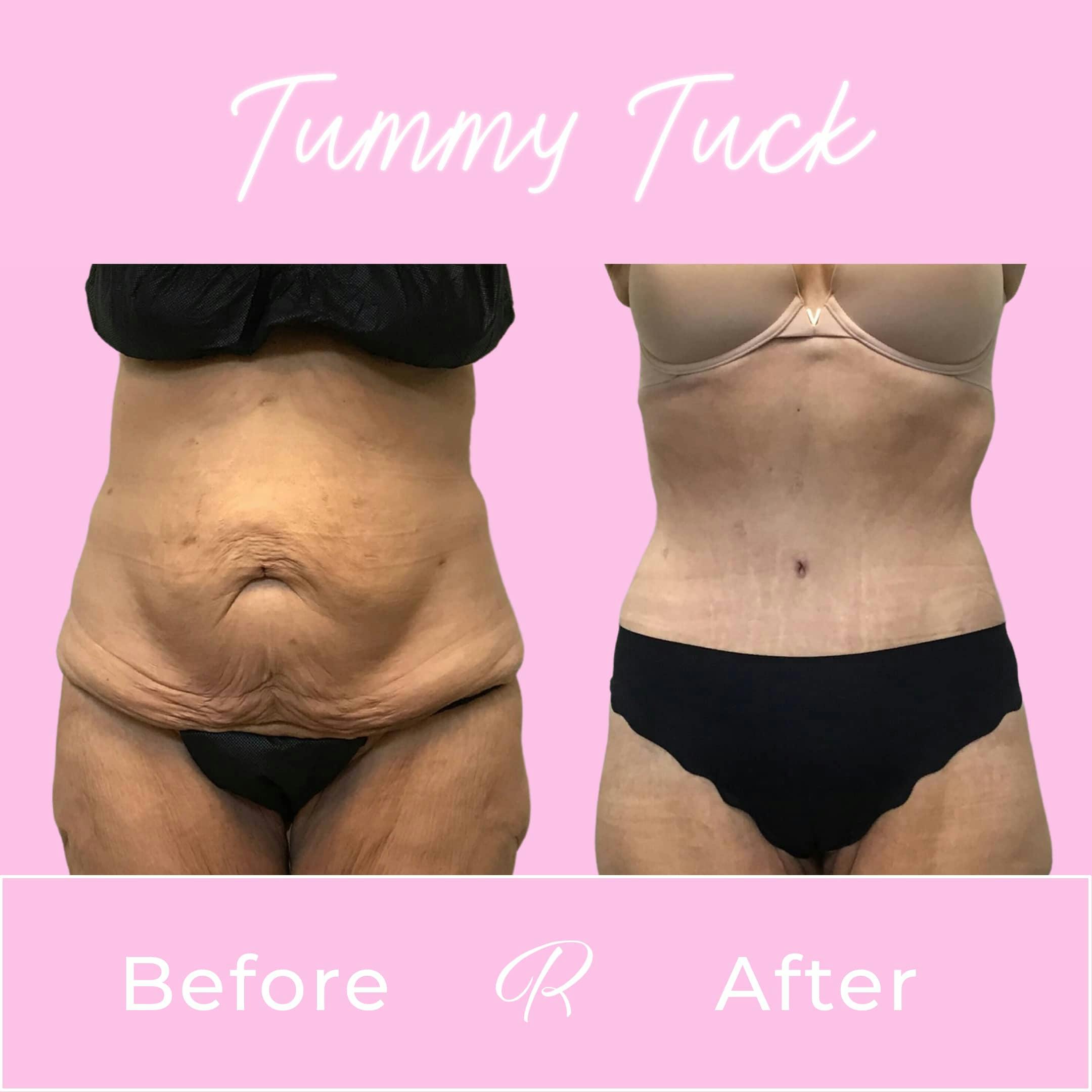 Tummy Tuck Before & After Gallery - Patient 133227669 - Image 1