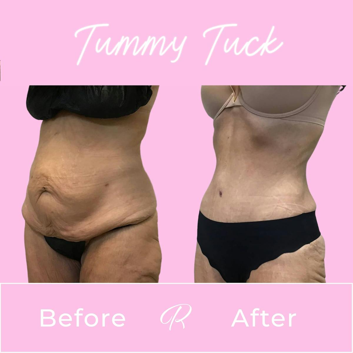 Tummy Tuck Before & After Gallery - Patient 133227669 - Image 2