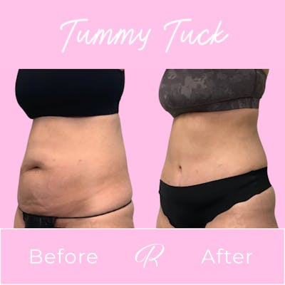 Tummy Tuck Before & After Gallery - Patient 133227670 - Image 1