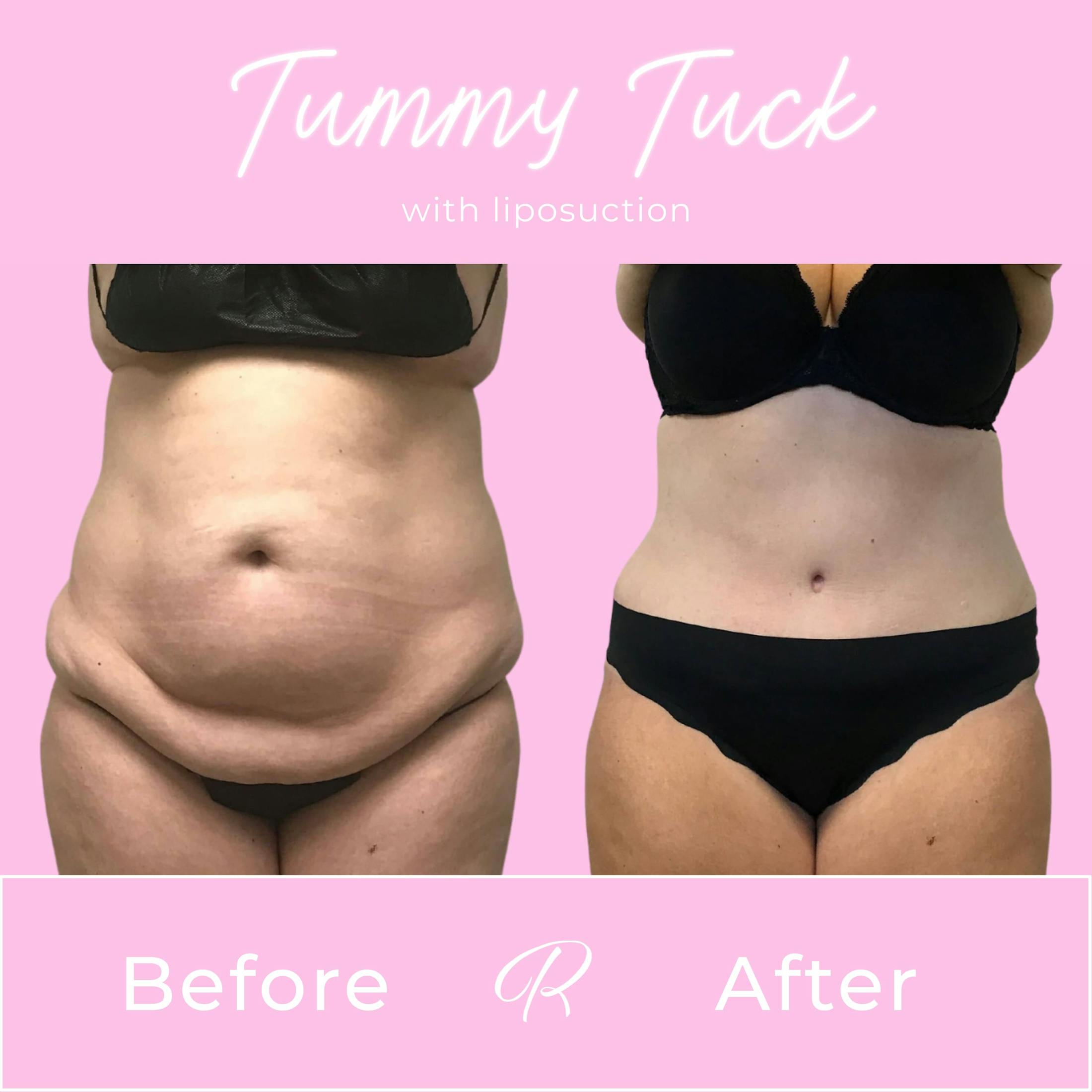 Tummy Tuck Before & After Gallery - Patient 133227671 - Image 1