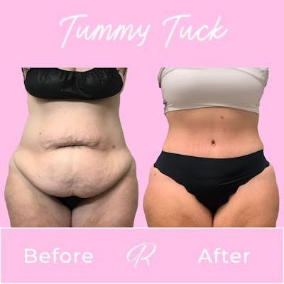 Tummy Tuck Before & After Gallery - Patient 133227672 - Image 1