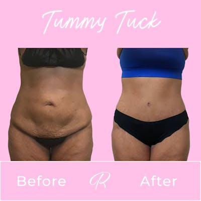 Tummy Tuck Before & After Gallery - Patient 133227673 - Image 1
