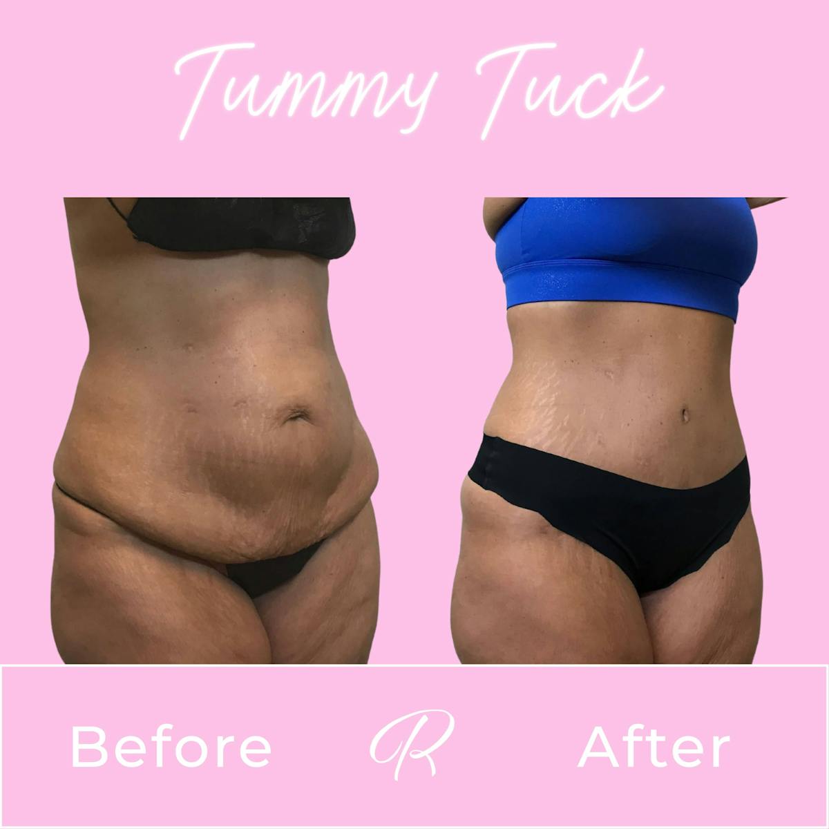 Tummy Tuck Before & After Gallery - Patient 133227673 - Image 2