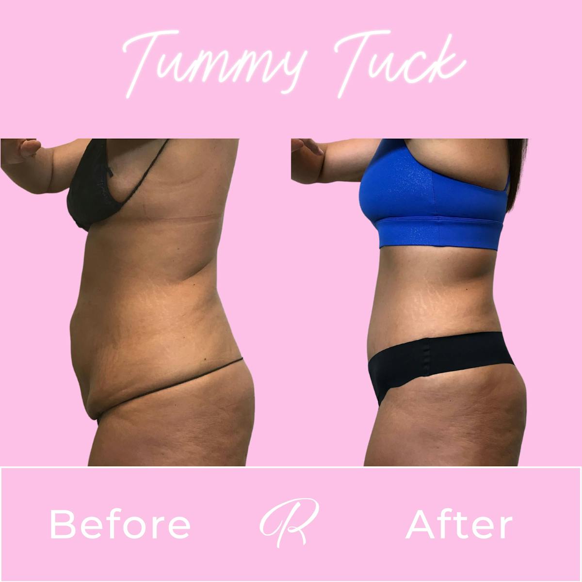 Tummy Tuck Before & After Gallery - Patient 133227673 - Image 3