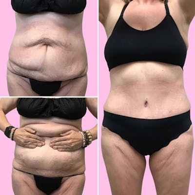 Tummy Tuck Before & After Gallery - Patient 133227684 - Image 1