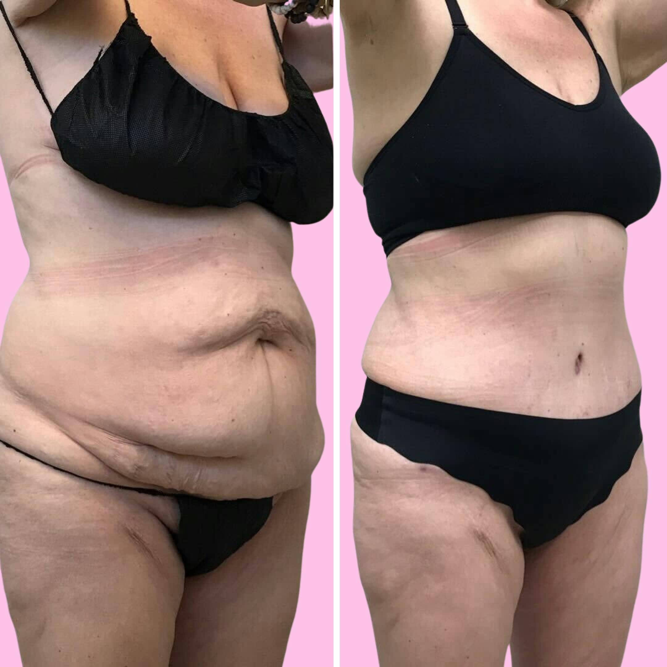 Tummy Tuck Before & After Gallery - Patient 133227684 - Image 2