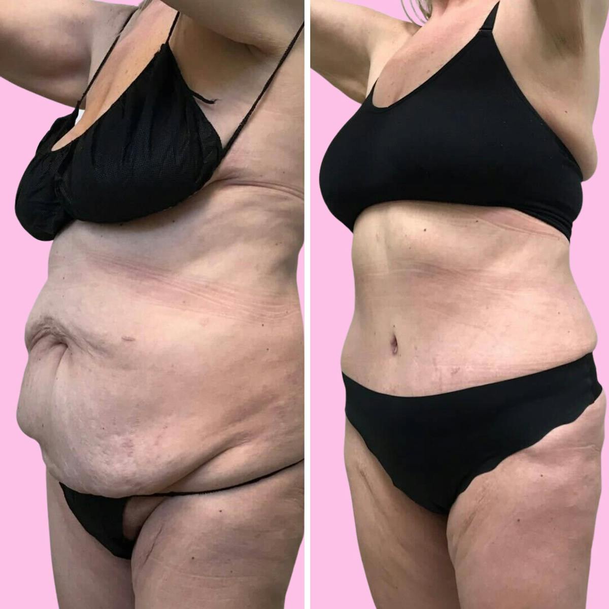 Tummy Tuck Before & After Gallery - Patient 133227684 - Image 3