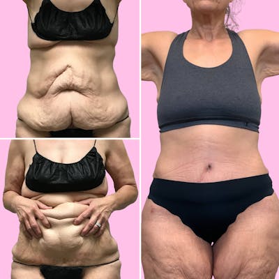 Tummy Tuck Before & After Gallery - Patient 133227685 - Image 1