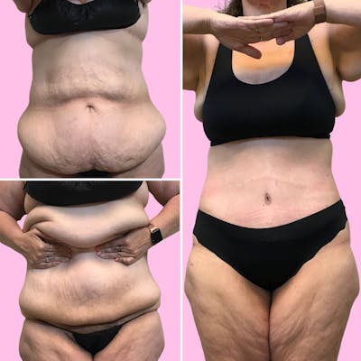 Tummy Tuck Before & After Gallery - Patient 133227686 - Image 1