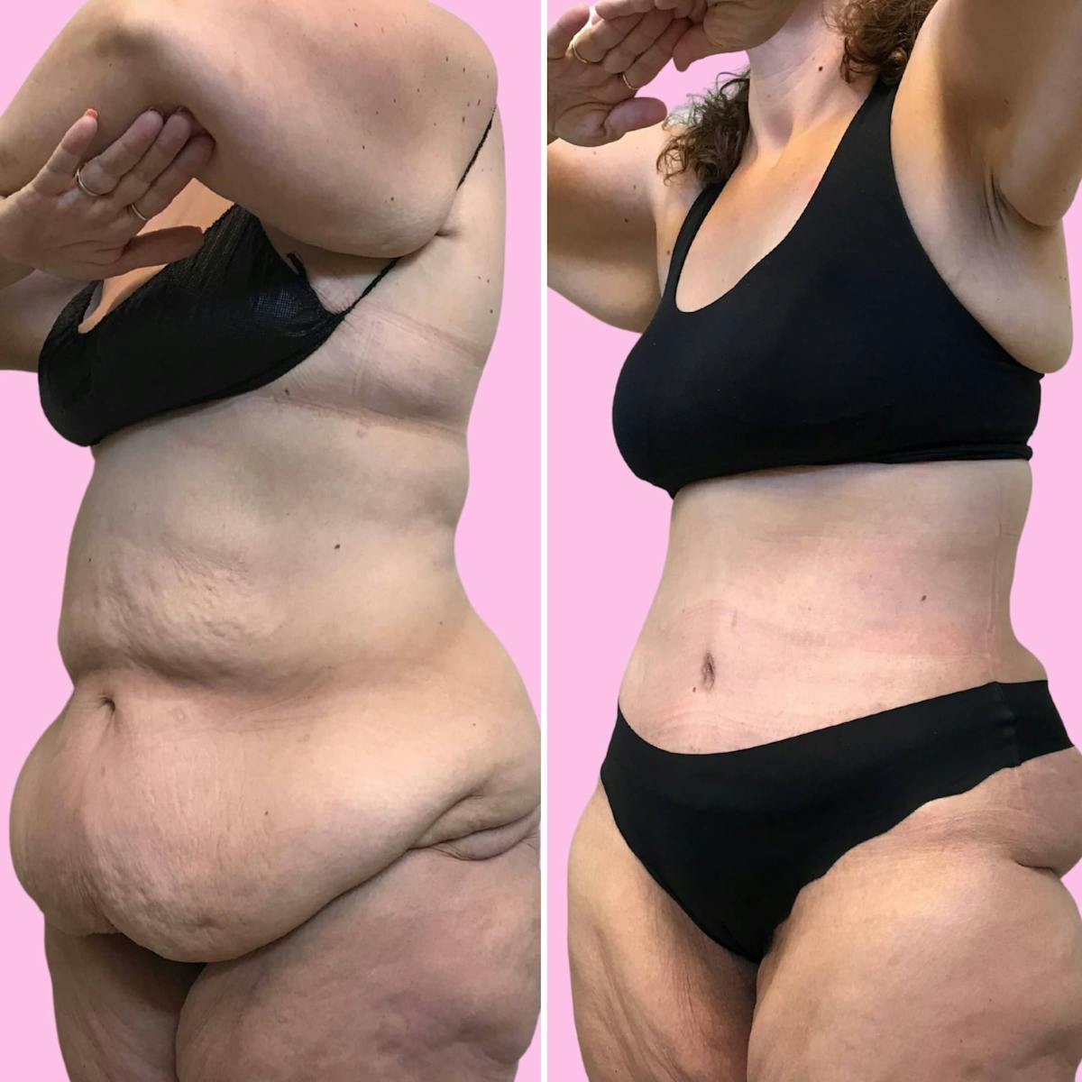 Tummy Tuck Before & After Gallery - Patient 133227686 - Image 2