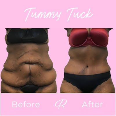 Tummy Tuck Before & After Gallery - Patient 133227687 - Image 1