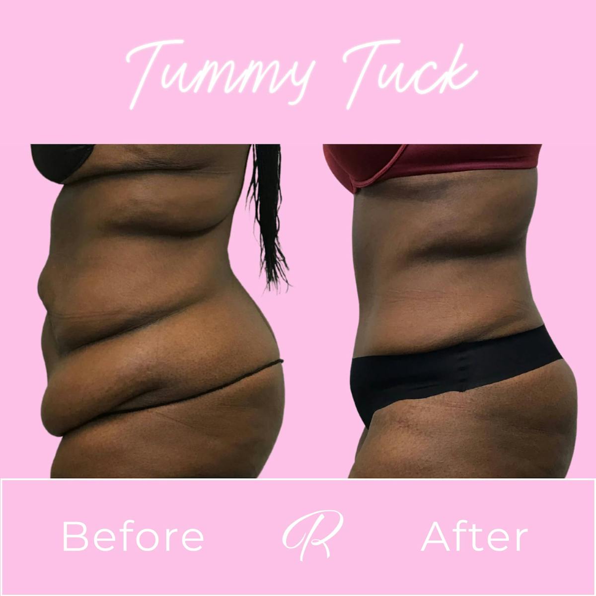 Tummy Tuck Before & After Gallery - Patient 133227687 - Image 2