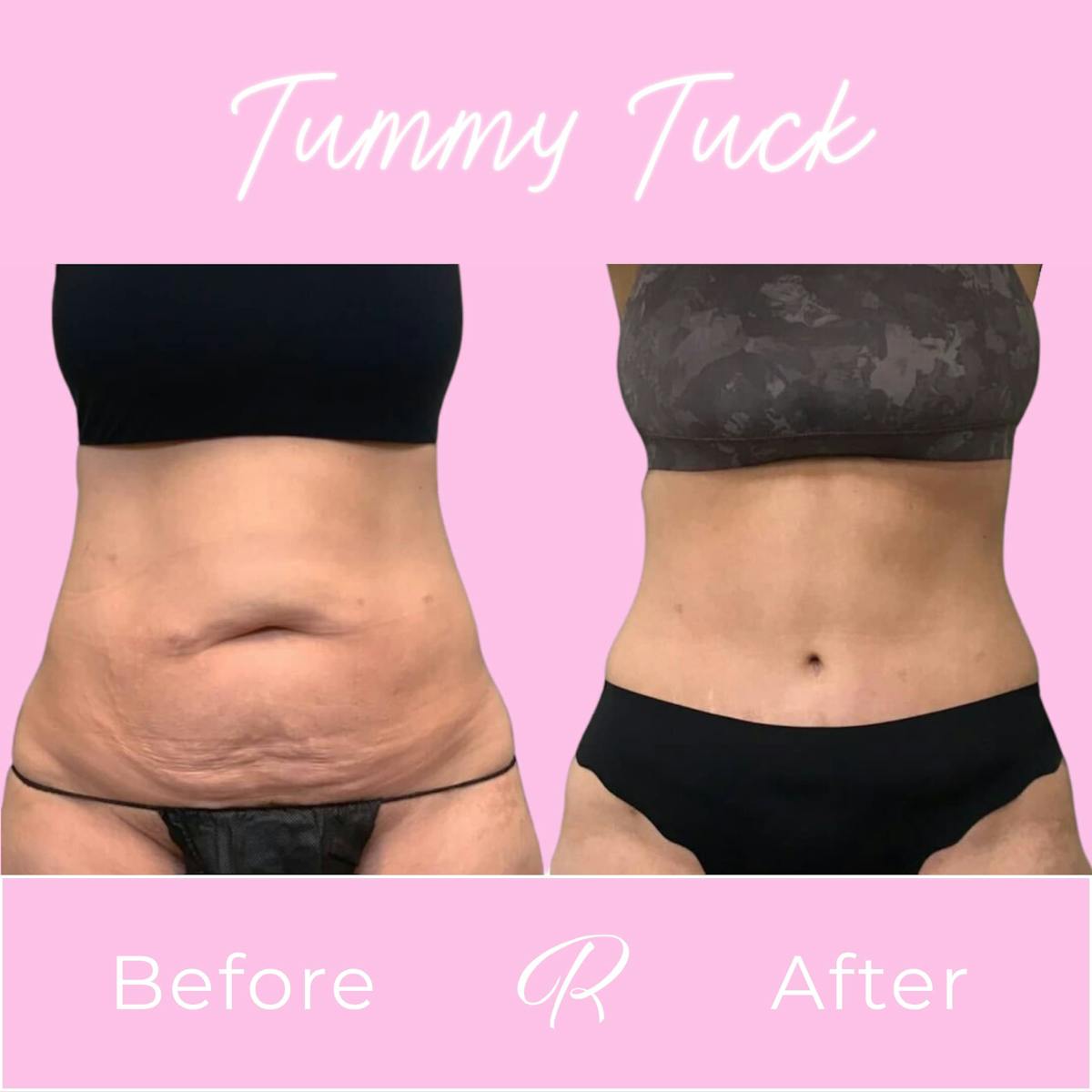 Tummy Tuck Before & After Gallery - Patient 133227688 - Image 1