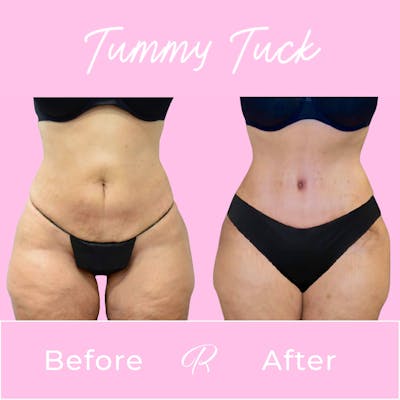 Tummy Tuck Before & After Gallery - Patient 133227691 - Image 1