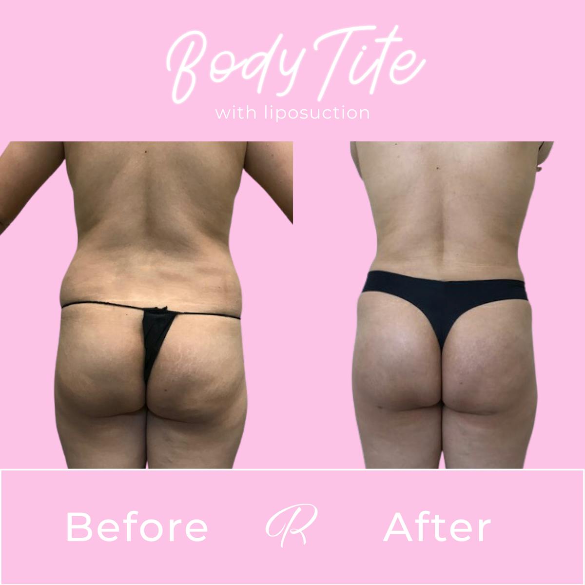 BodyTite Before & After Gallery - Patient 165330813 - Image 3