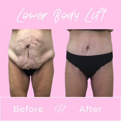 Lower Body Lift Before & After Gallery - Patient 165332996 - Image 1