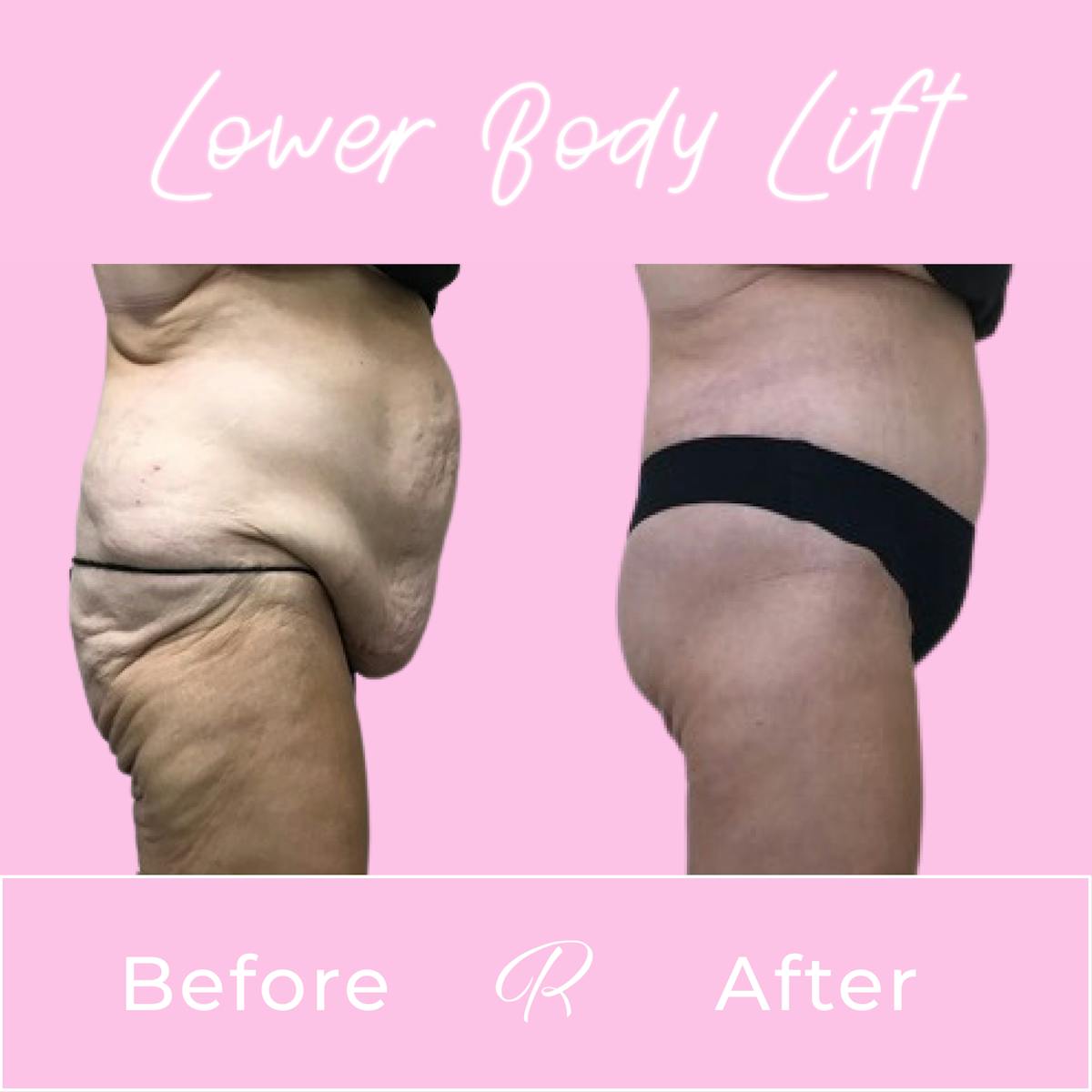 Lower Body Lift Before & After Gallery - Patient 165332996 - Image 2