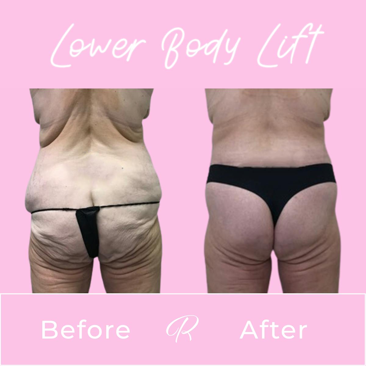 Lower Body Lift Before & After Gallery - Patient 165332996 - Image 3