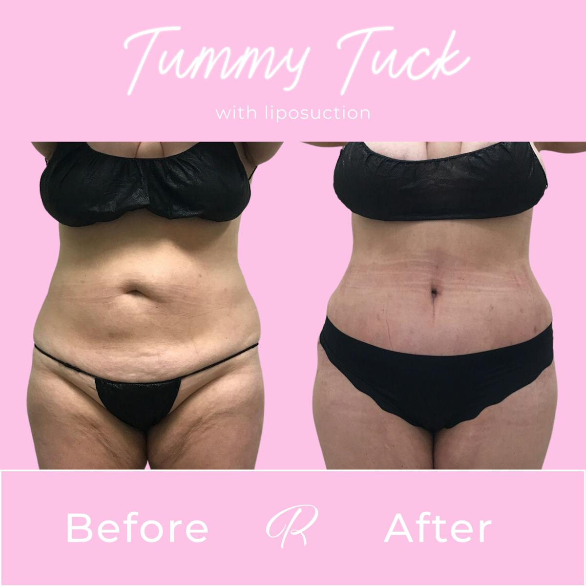 Tummy Tuck Before & After Gallery - Patient 183077034 - Image 1