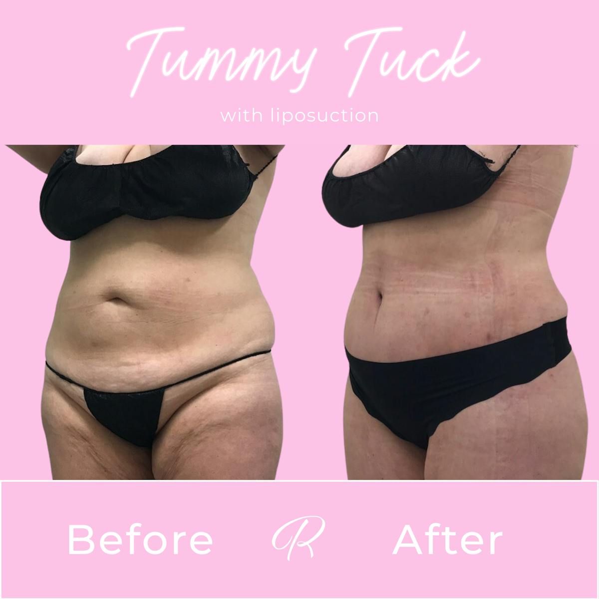 Tummy Tuck Before & After Gallery - Patient 183077034 - Image 2