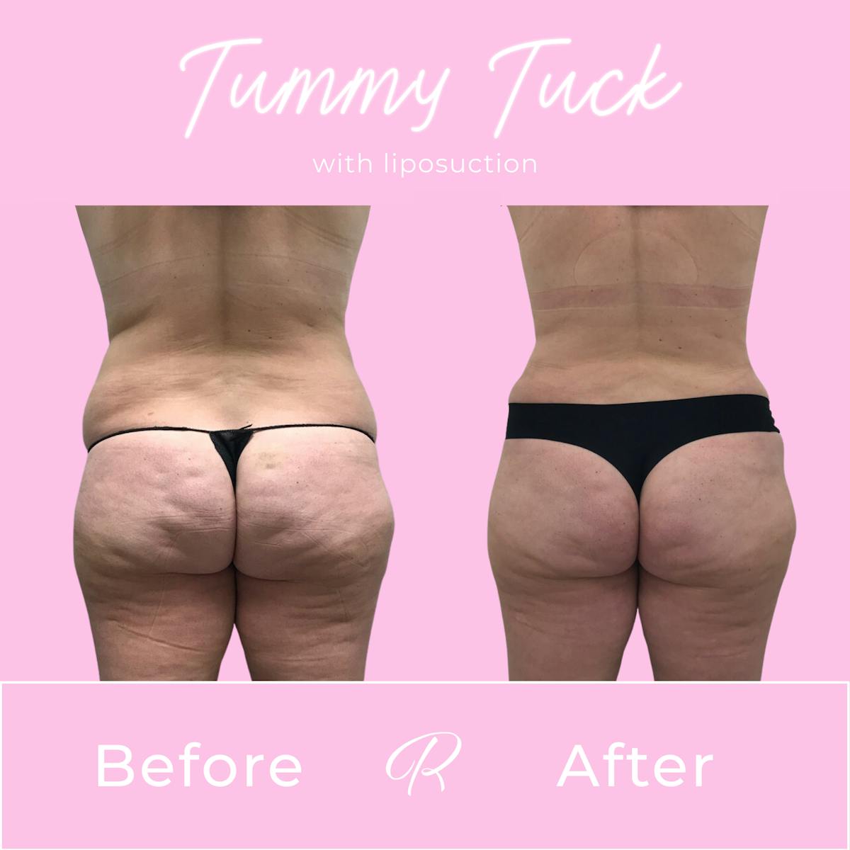 Tummy Tuck Before & After Gallery - Patient 183077034 - Image 3
