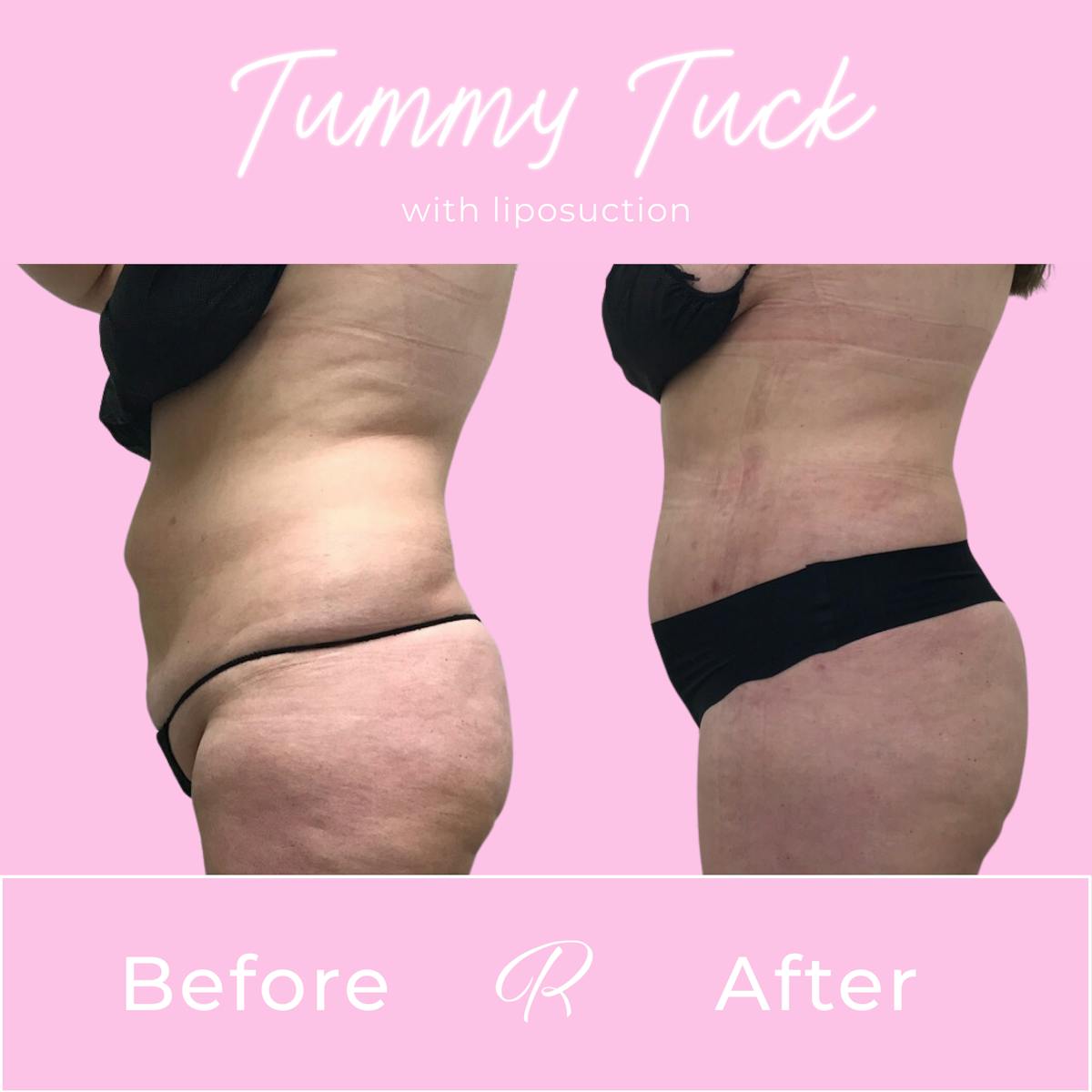 Tummy Tuck Before & After Gallery - Patient 183077034 - Image 4
