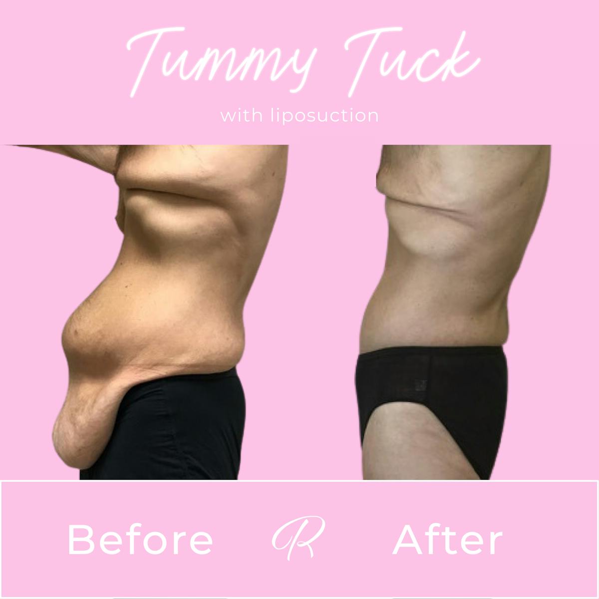 Tummy Tuck Before & After Gallery - Patient 183077053 - Image 2