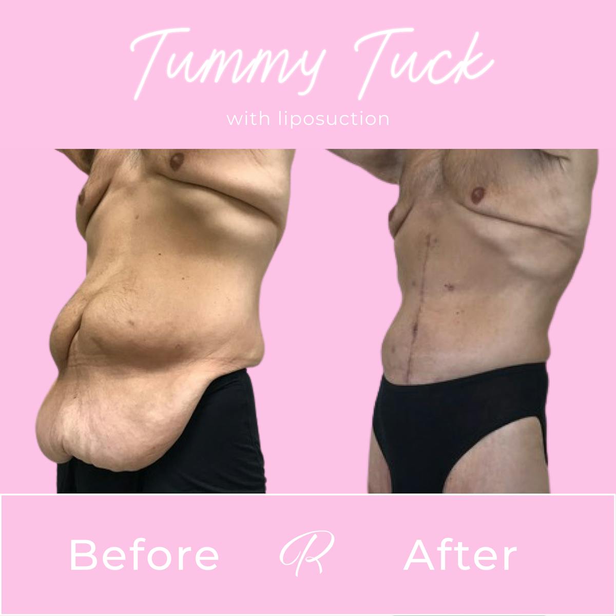 Tummy Tuck Before & After Gallery - Patient 183077053 - Image 3