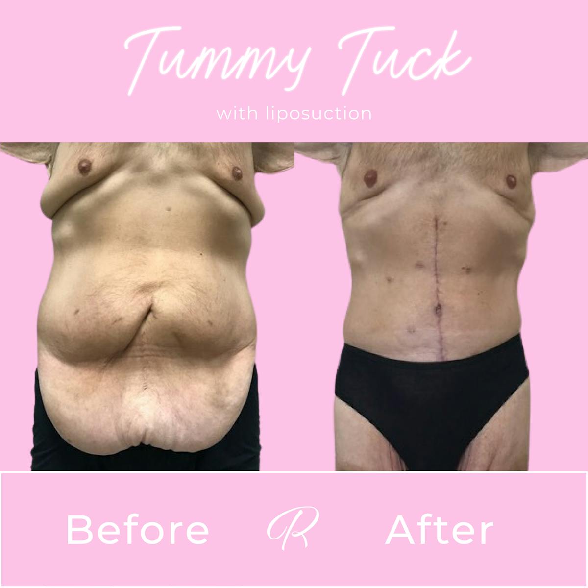 Tummy Tuck Before & After Gallery - Patient 183077053 - Image 1