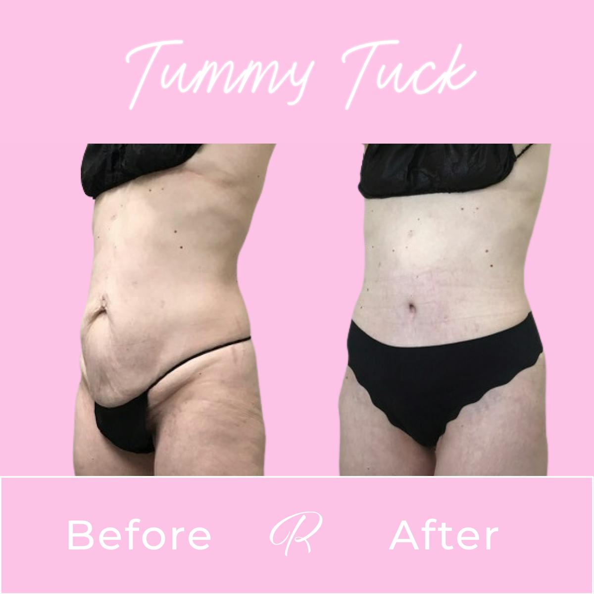 Tummy Tuck Before & After Gallery - Patient 183077052 - Image 2