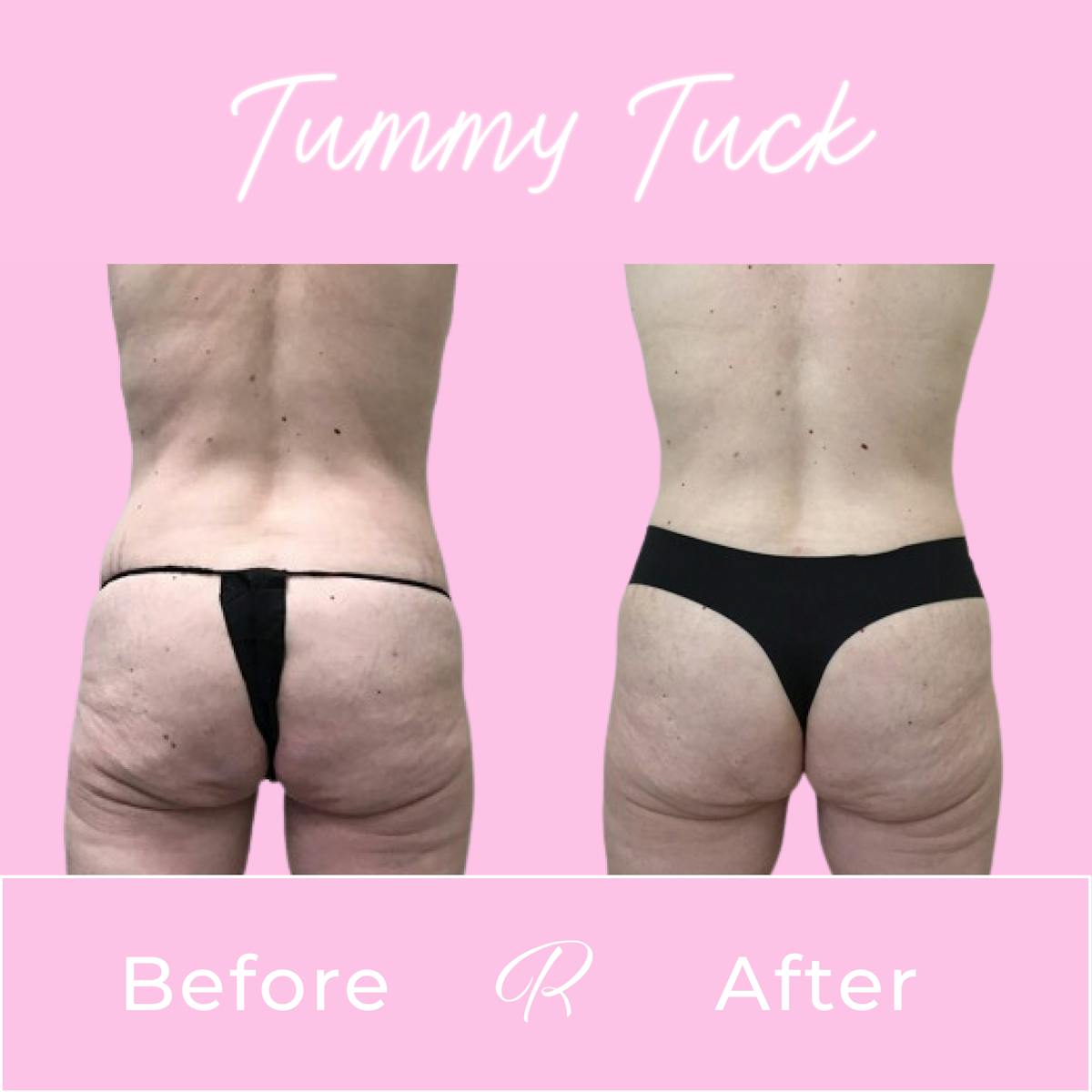 Tummy Tuck Before & After Gallery - Patient 183077052 - Image 3