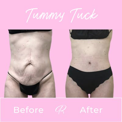 Tummy Tuck Before & After Gallery - Patient 183077052 - Image 1
