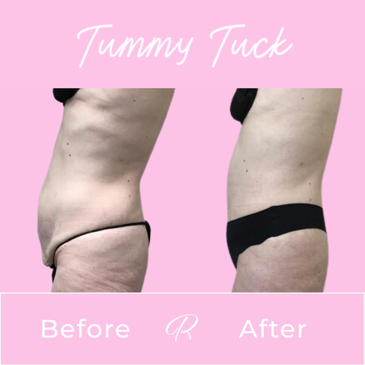 Tummy Tuck Before & After Gallery - Patient 183077052 - Image 4