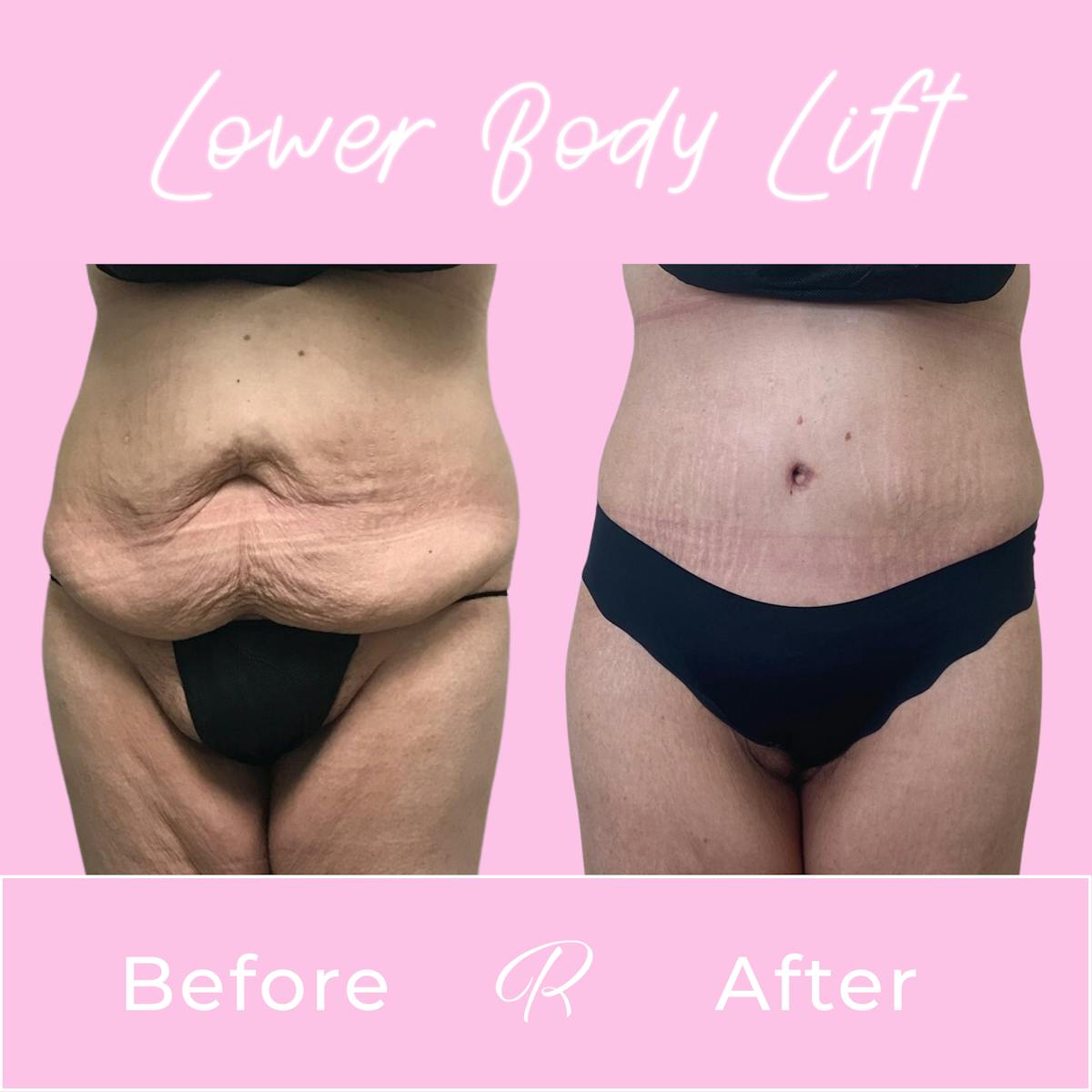 Lower Body Lift Before & After Gallery - Patient 183077022 - Image 1