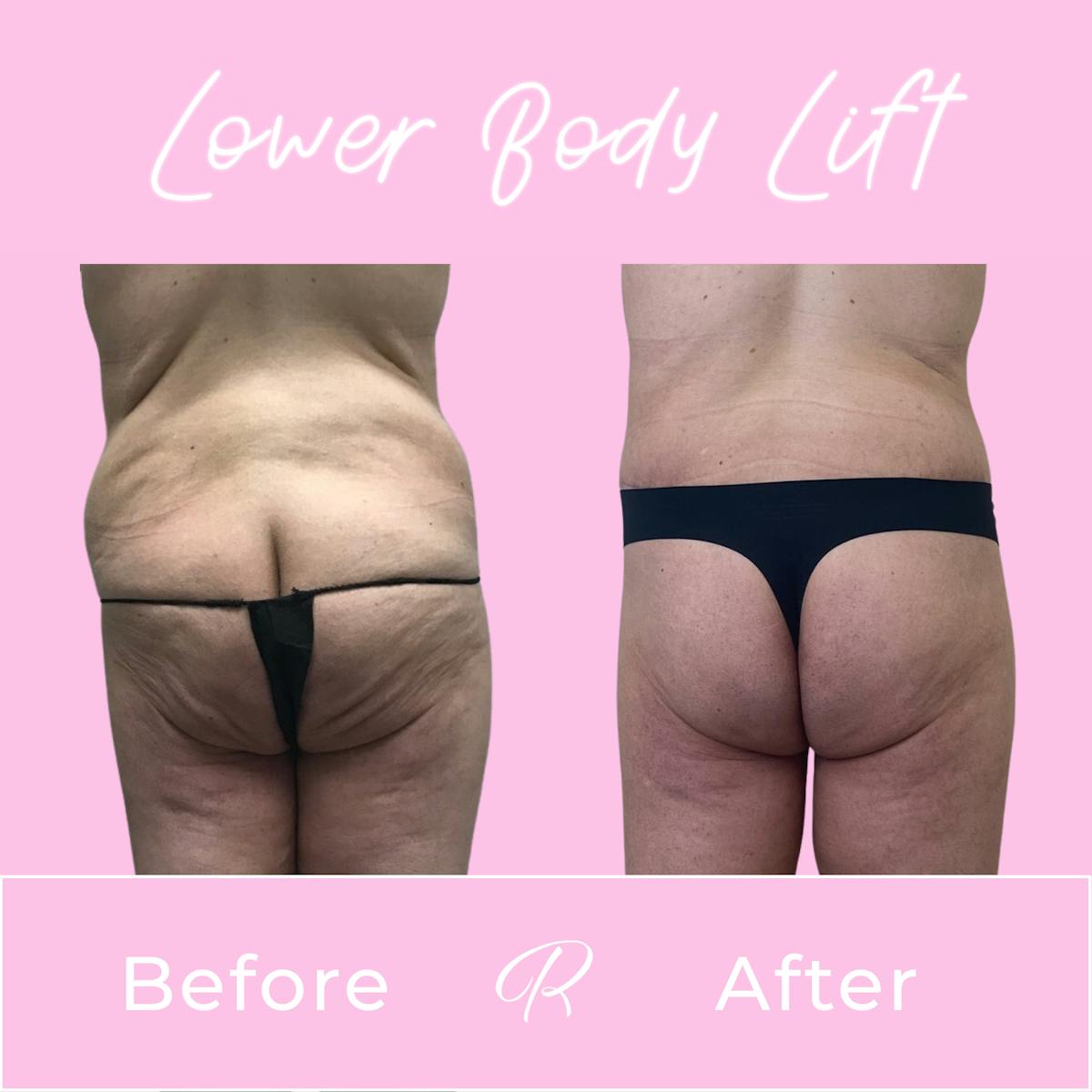 Lower Body Lift Before & After Gallery - Patient 183077022 - Image 3
