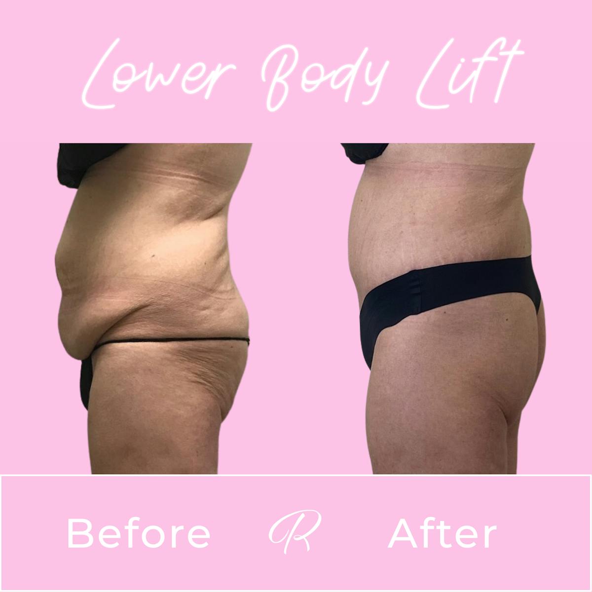 Lower Body Lift Before & After Gallery - Patient 183077022 - Image 2